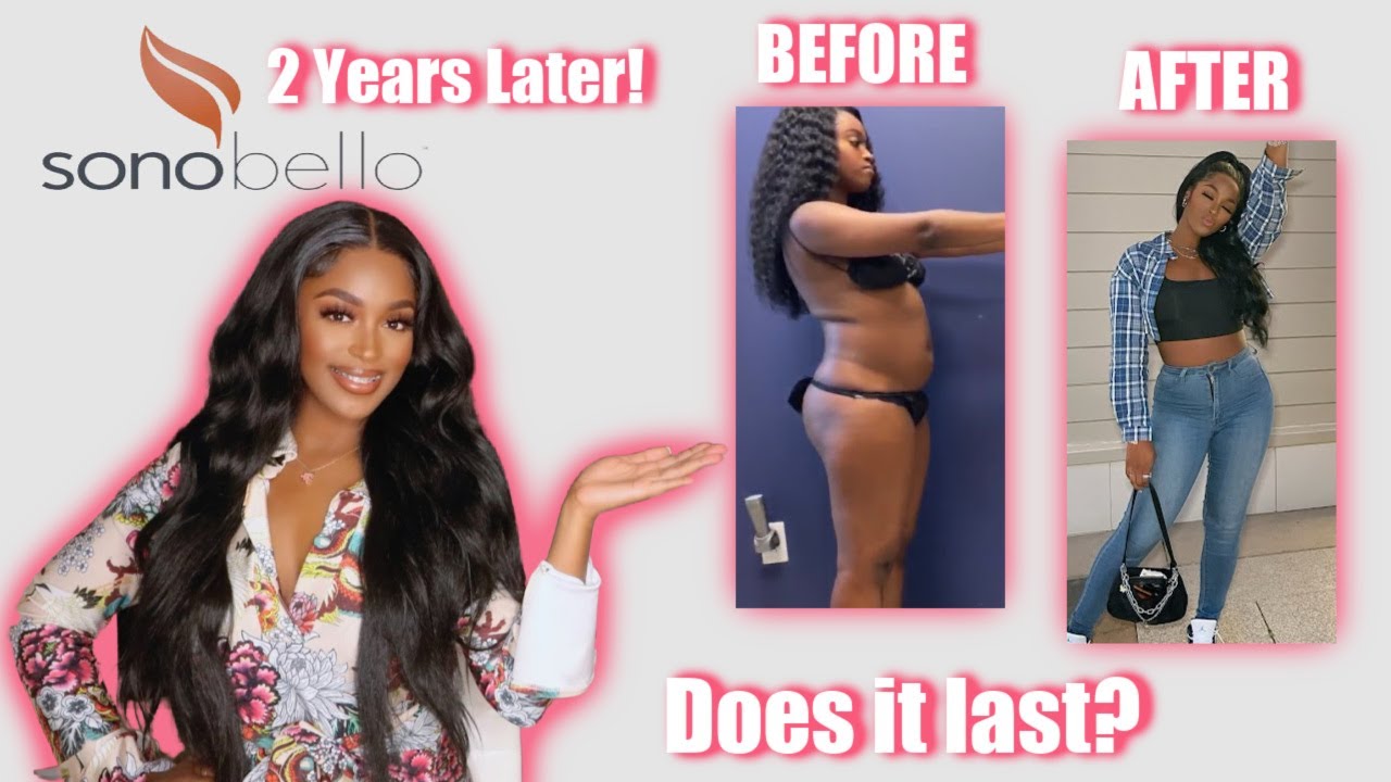 Does it LAST? | Sono Bello 2 Year Update | #AD