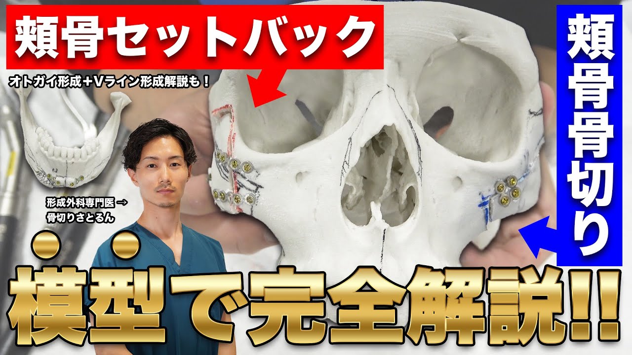 【小顔】模型で手術を完全解説！頬骨骨切りってどんな手術？【骨切りさとるん】