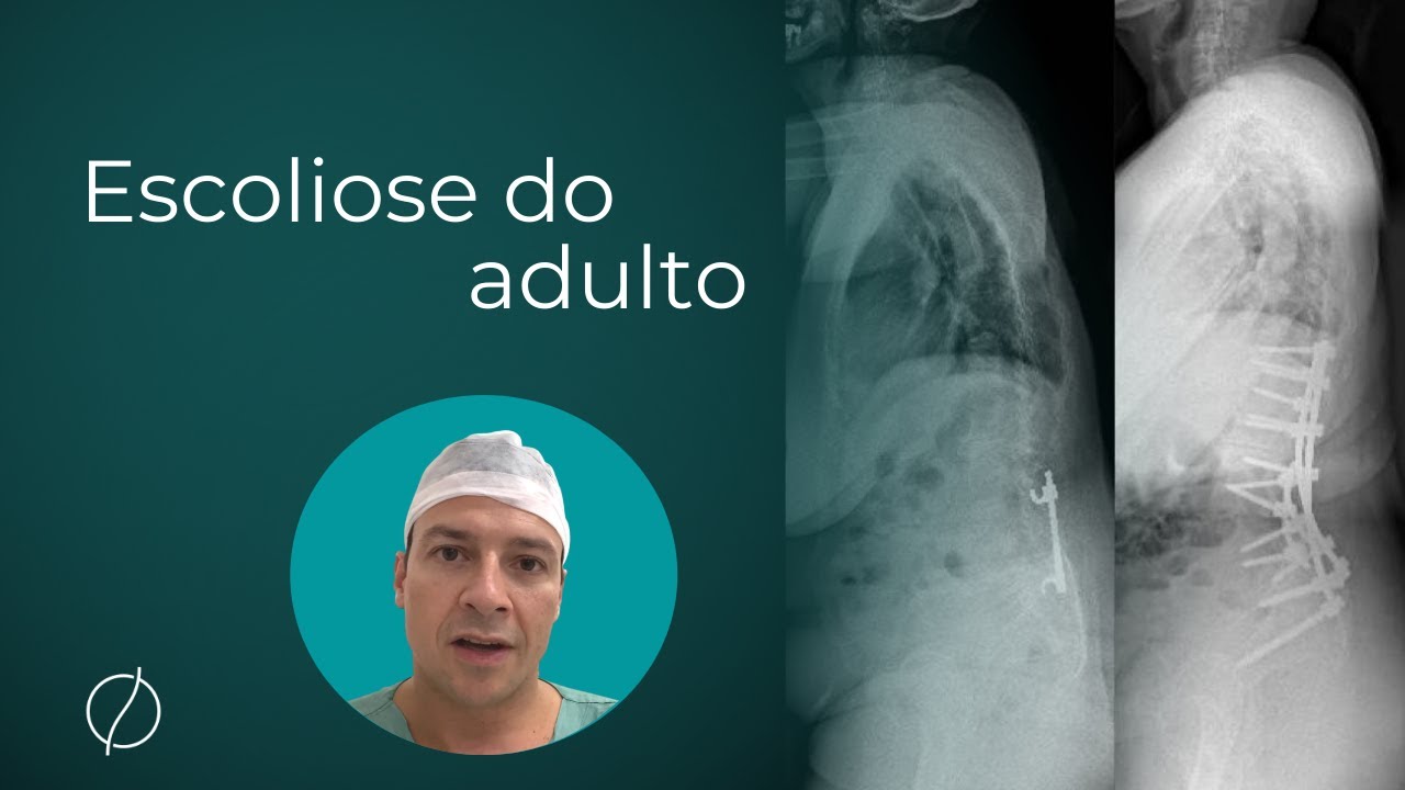 Escoliose do Adulto - Cirurgia de escoliose em adulto