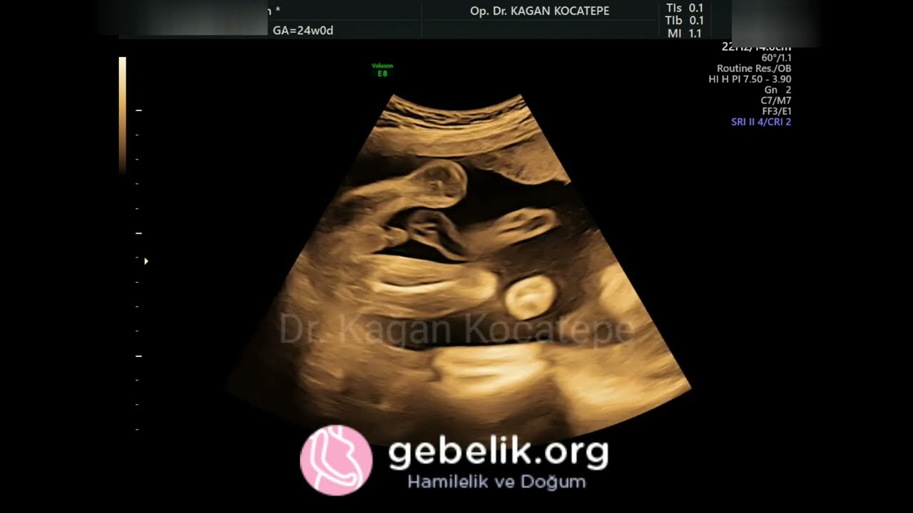 How is the genital area seen of the baby in the womb on ultrasound? Is this a boy or a girl?  Guess!