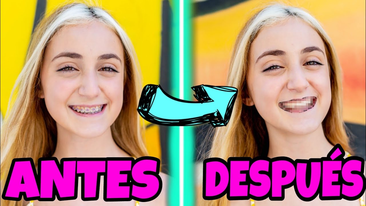 ME QUITAN LOS BRACKETS 😁 REACCIÓN del MEJOR DÍA DE MI VIDA