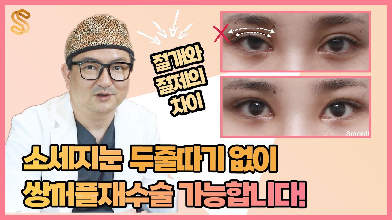 속지마세요! 두줄따기 안해도 절개로 쌍꺼풀재수술 가능해요, 절제와 절개의 차이점 # 소세지눈재수술