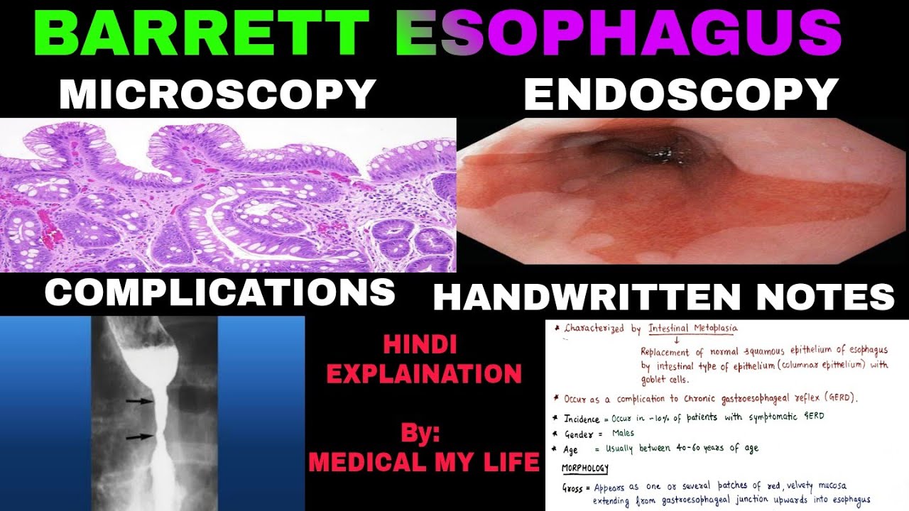 Barrett's Esophagus | Pathology