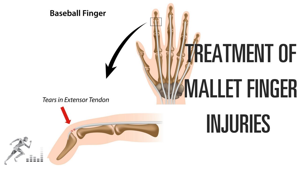 Mallet finger: Treatment of this difficult finger injury
