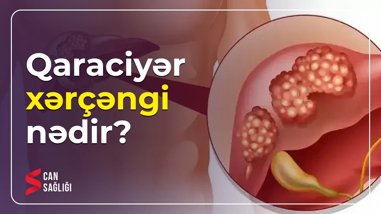 Qaraciyər xərçəngi risk faktorları hansılardır? - Can Sağlığı (17.07.2023)