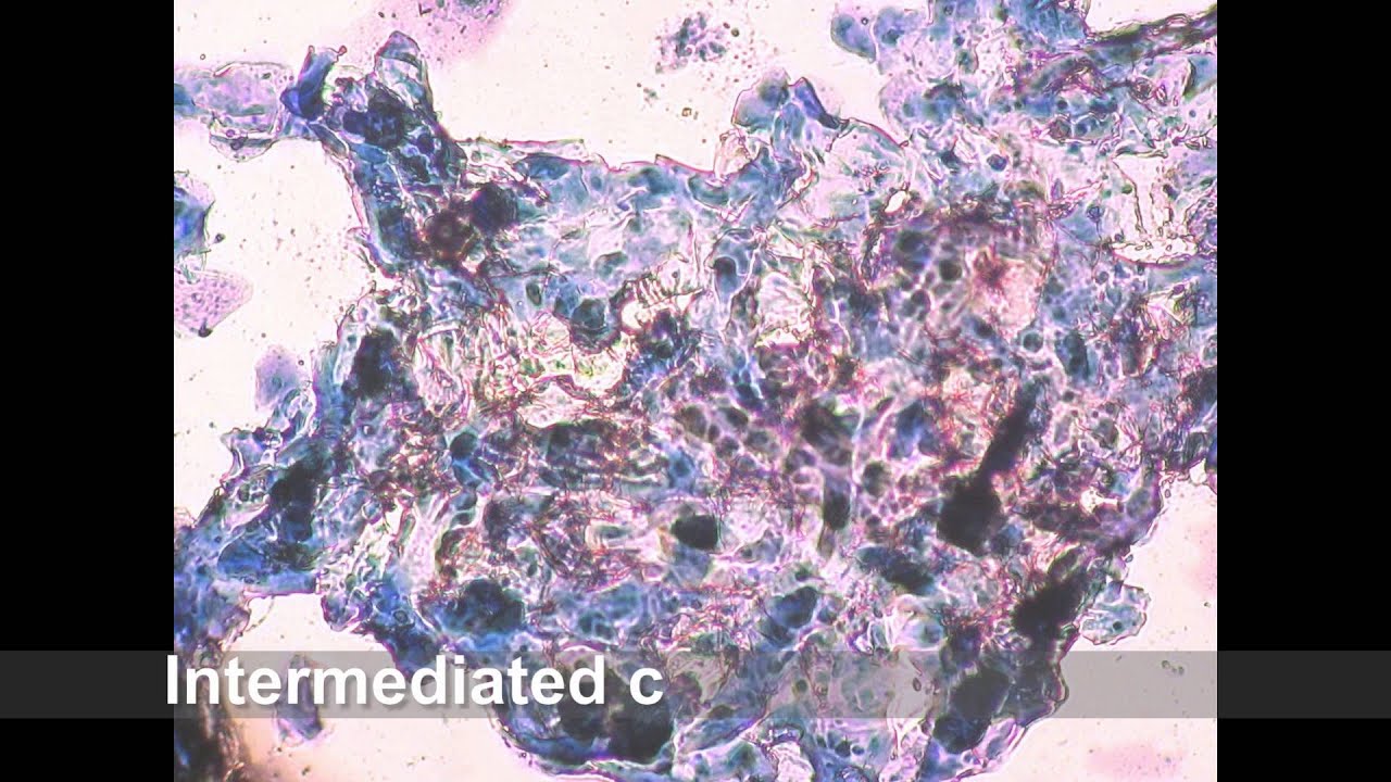Normal vaginal cell proestrus to diestrus