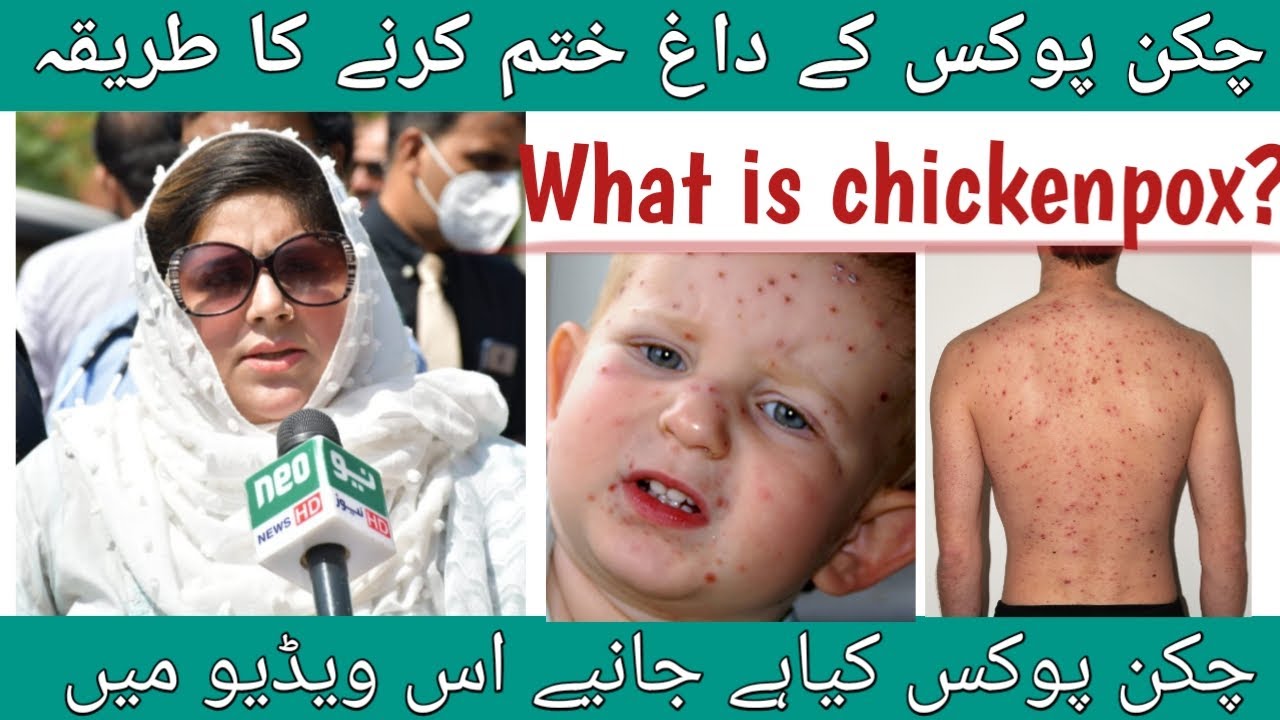 What is Chickenpox,Causes ,Treatment ,Remove Chickenpox Scars|Urdu |Hindi |Dr Nagina Shahzadi