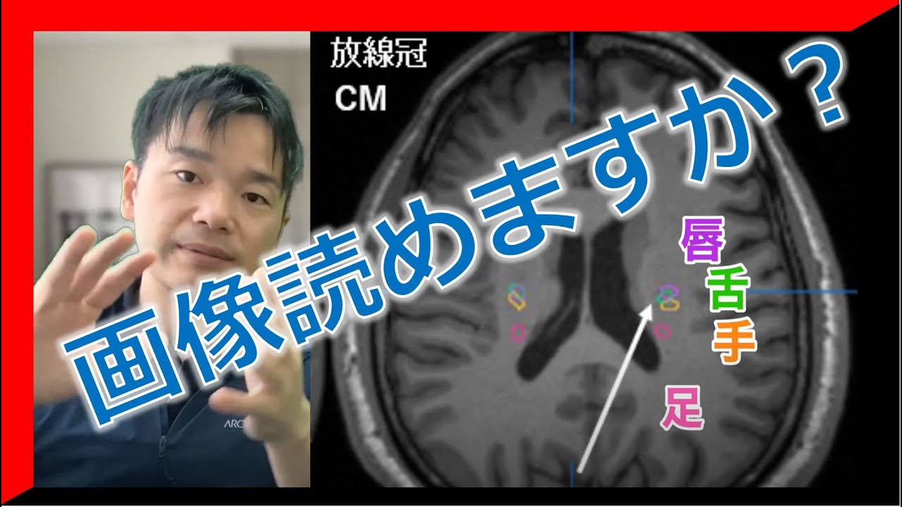 皮質脊髄路/皮質延髄路の脳画像とリハビリテーションへの応用