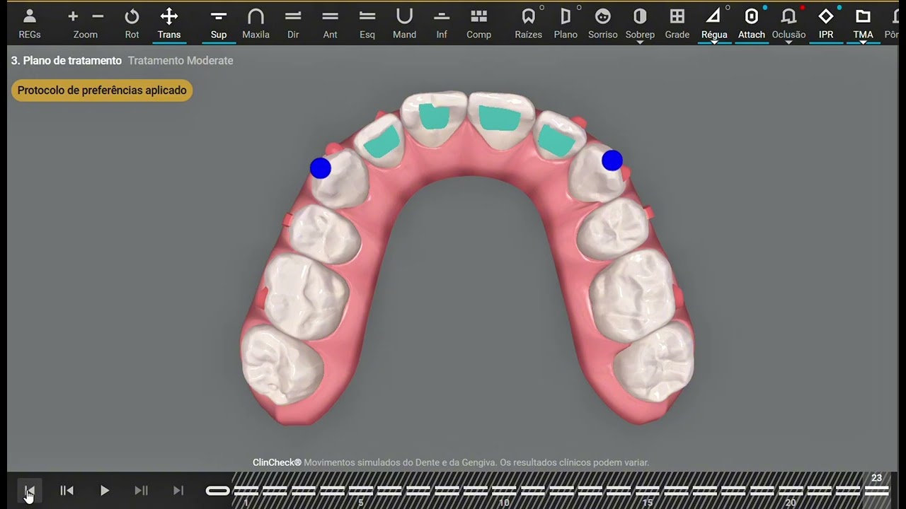 Motivational Invisalign Moderate ClinCheck Simulation | Severe Crowding & Collapsed Occlusion