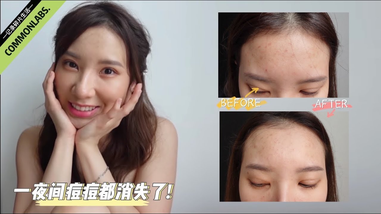 【护肤篇】熬夜熬出满脸痘 只需简单几个步骤 一夜间痘痘全消失不见！