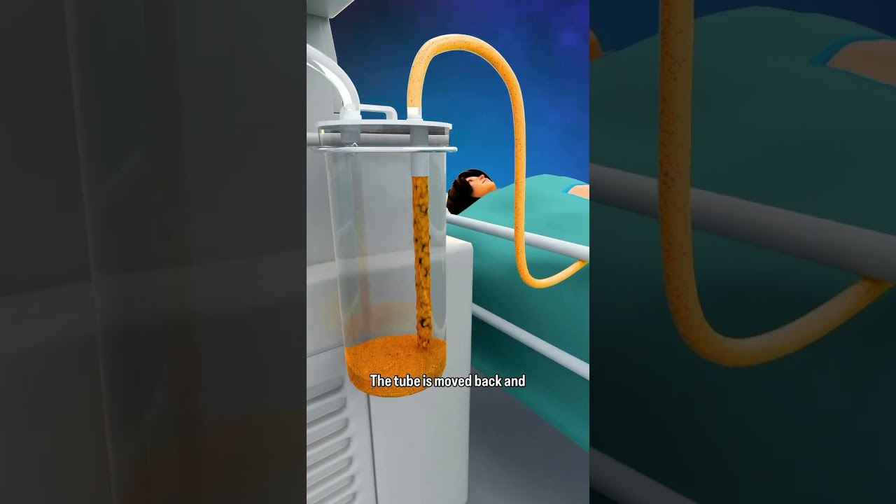 How Liposuction Works: Quick Overview #shorts - creativelearning3d