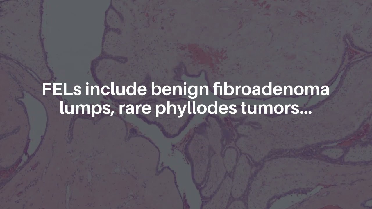 Oncotarget: Benign, Borderline, and Malignant Breast Tumors