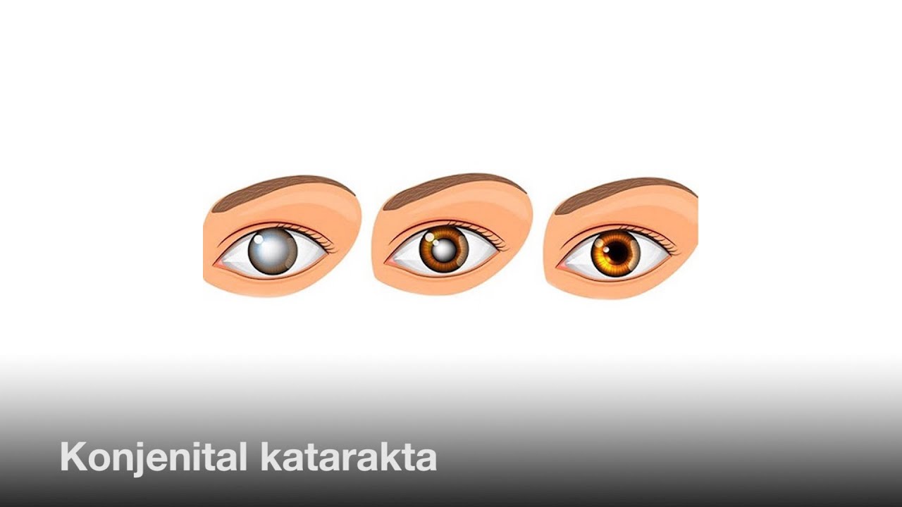 Konjenital katarakta (Anadangəlmə mirvari suyu) #RafadarXalilov