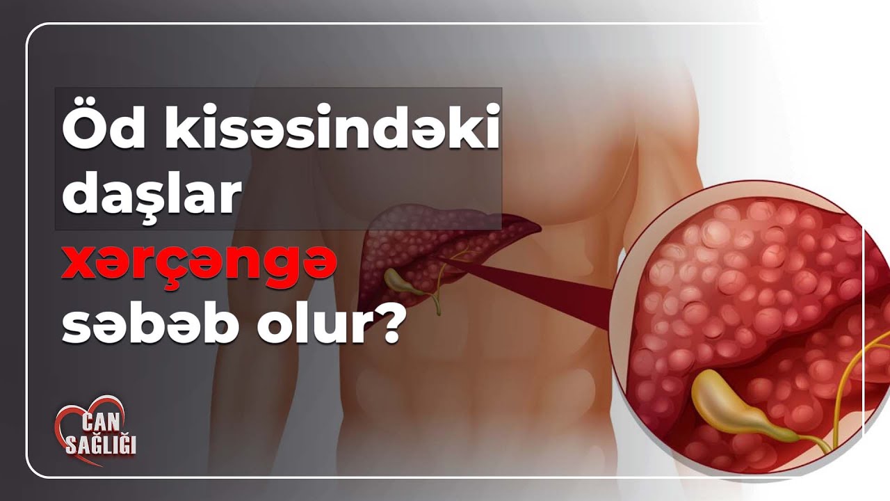 Öd kisəsi çıxarılmış insanlar nə etməlidir? - Can Sağlığı (13.03.2024)