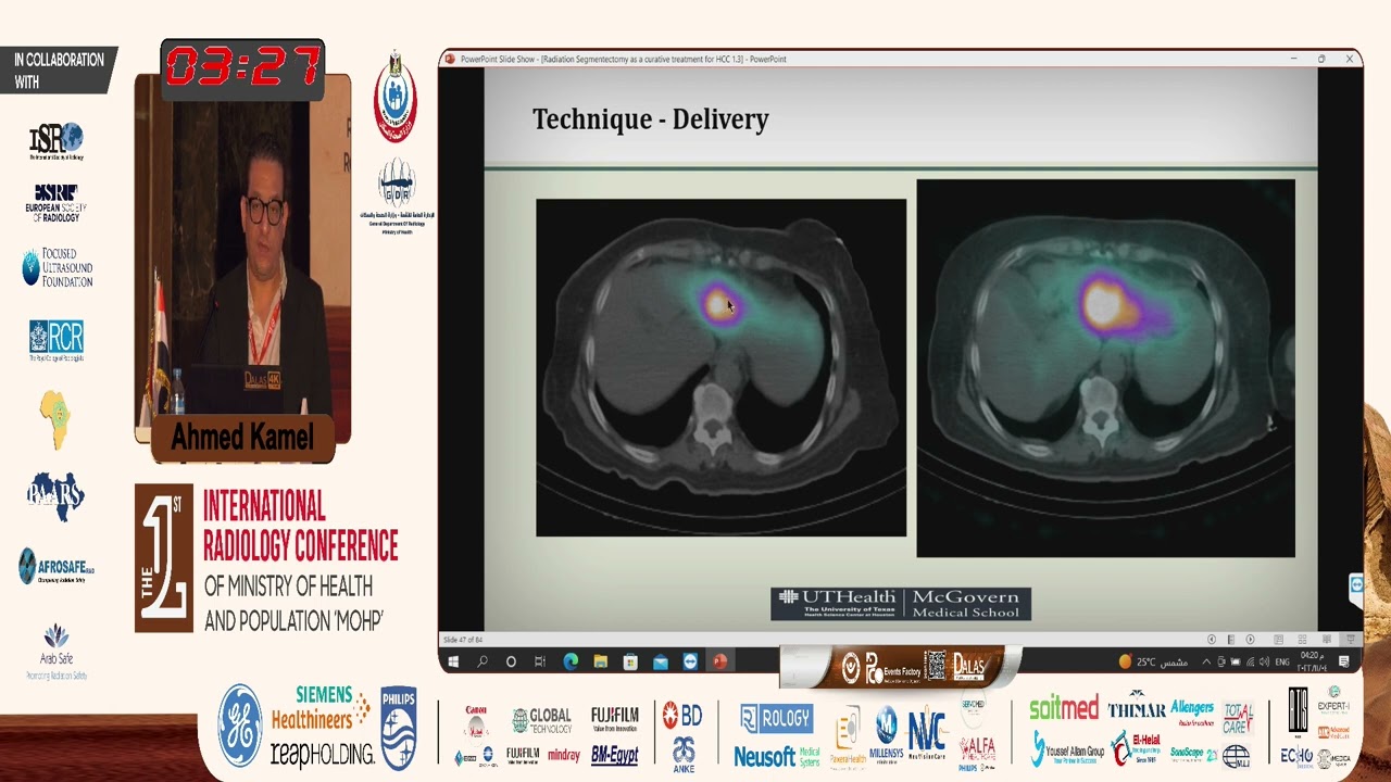 Radiation Segmentectomy as a Curative Treatnebt: are We There Yet?