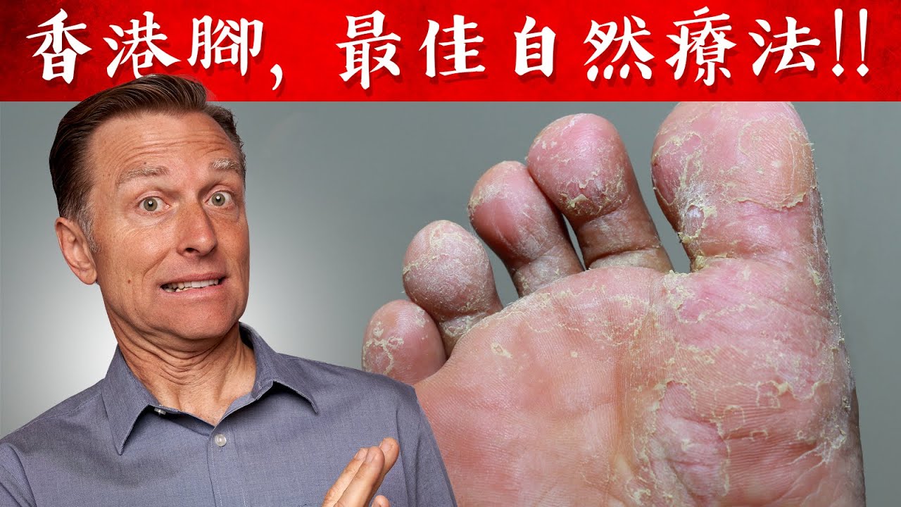 香港腳, 最佳自然療法,柏格醫生 Dr Berg