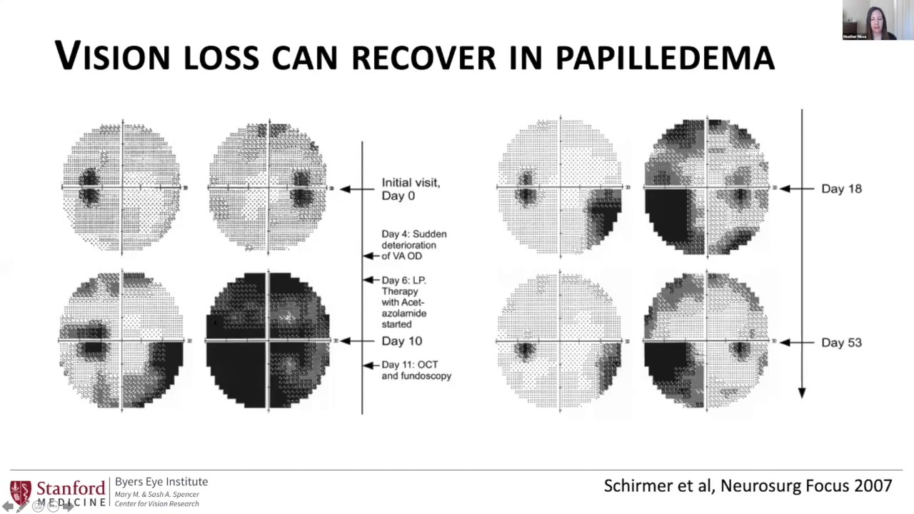 Clinical Presentation and History - Mechanism of vision loss in papilledema