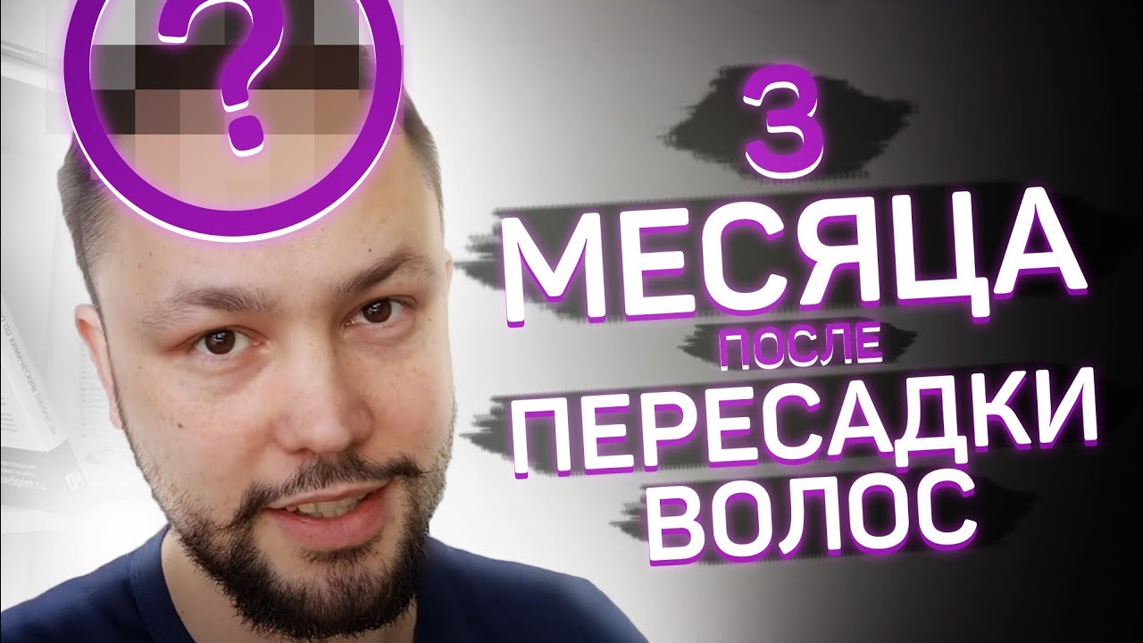 Пересадка волос. 3 месяца после операции.