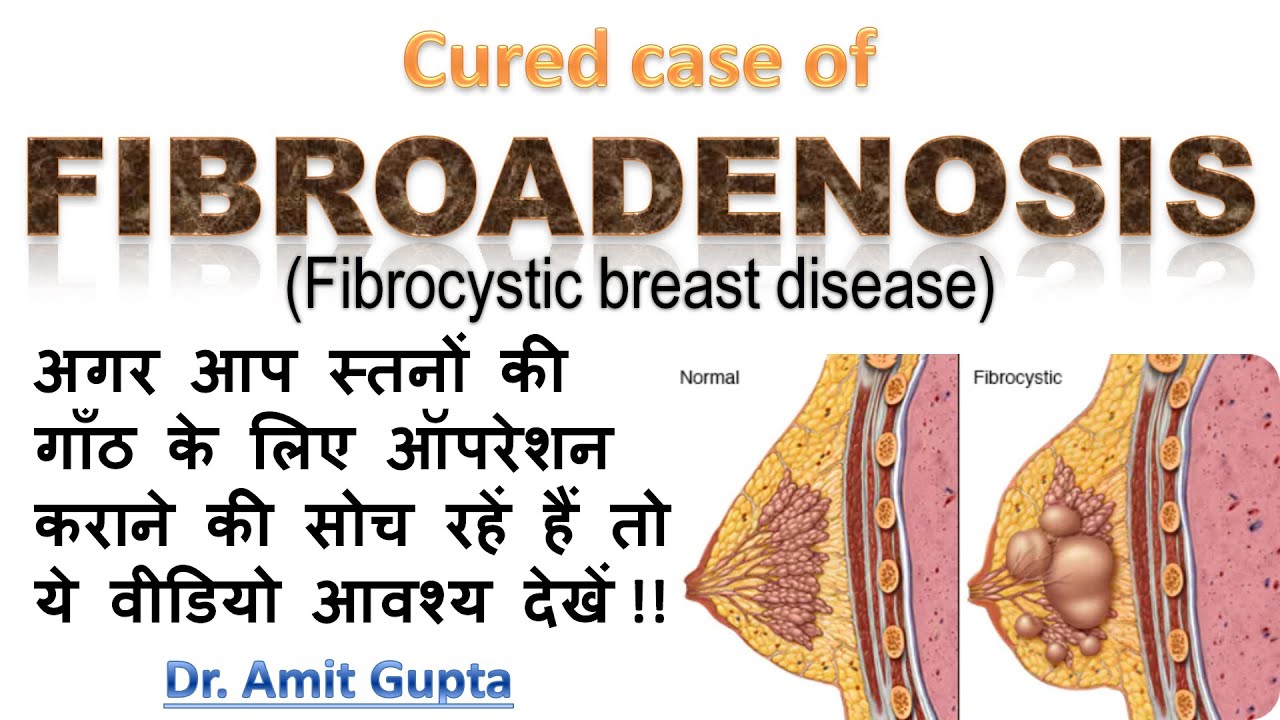 Fibroadenosis cured case