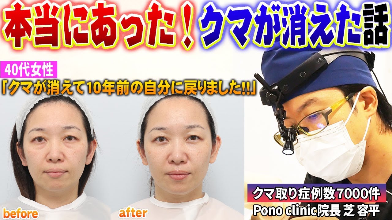 クマとたるみが同時に治る！驚異の裏ミッドフェイスリフトで10歳若返った40代女性のリアルストーリーを紹介します！本当にあったシリーズ