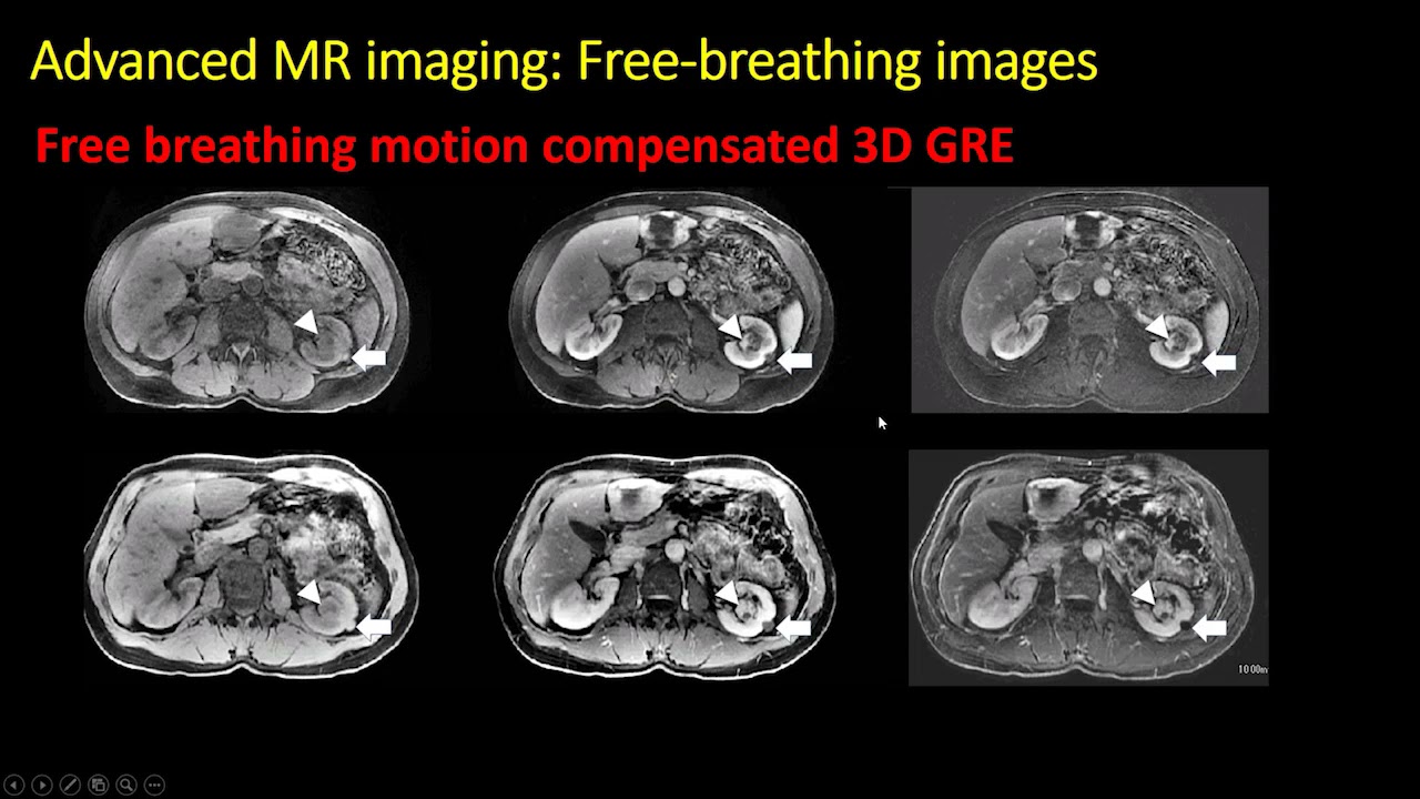 CT and MRI of renal masses