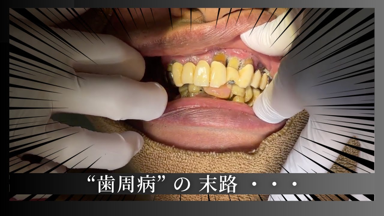 歯周病で歯が限界突破
