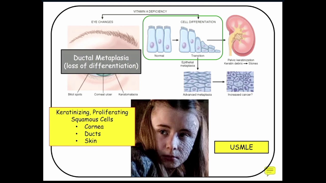 12DaysinMarch, Podcast Series, Cholestatic Jaundice for the USMLE Step One Exam
