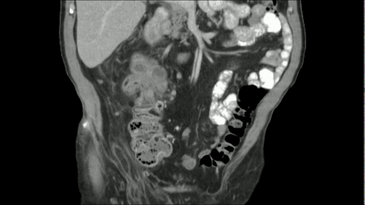 Dedifferentiated liposarcoma mimicking a primary colon mass - CT scan