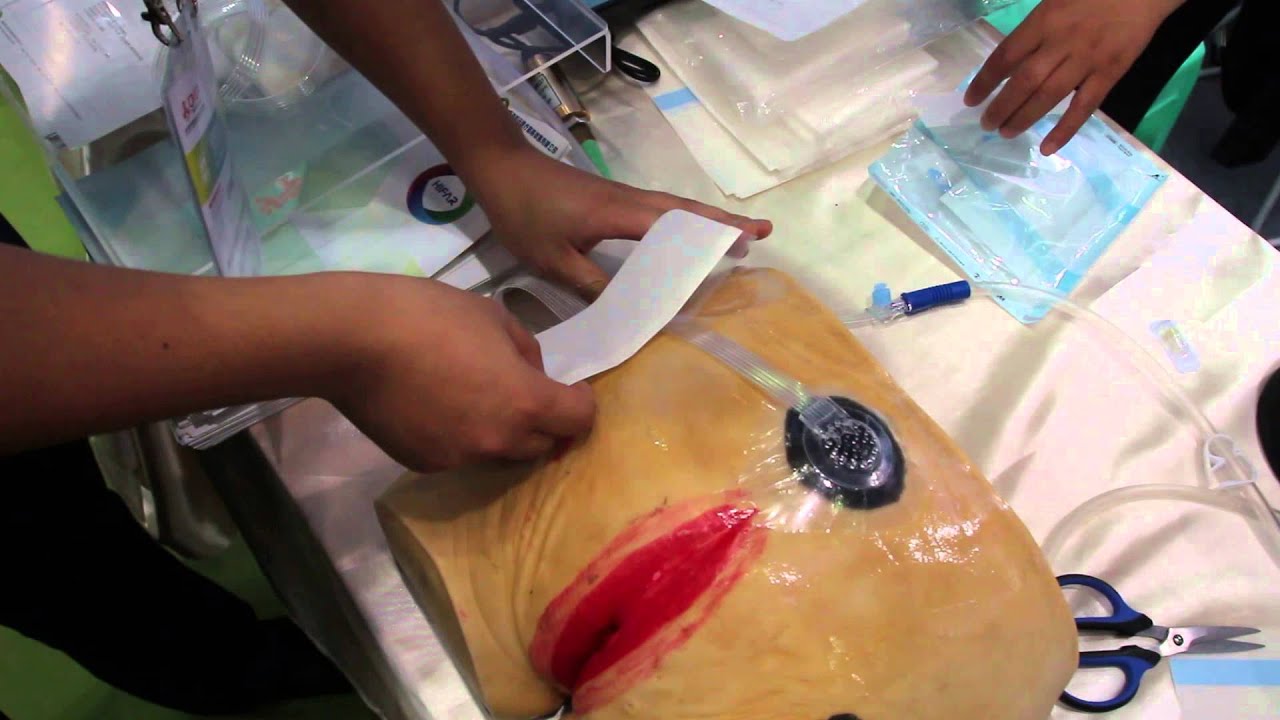 NPWT VAC Vacuum Negative Pressure wounds therapy machine