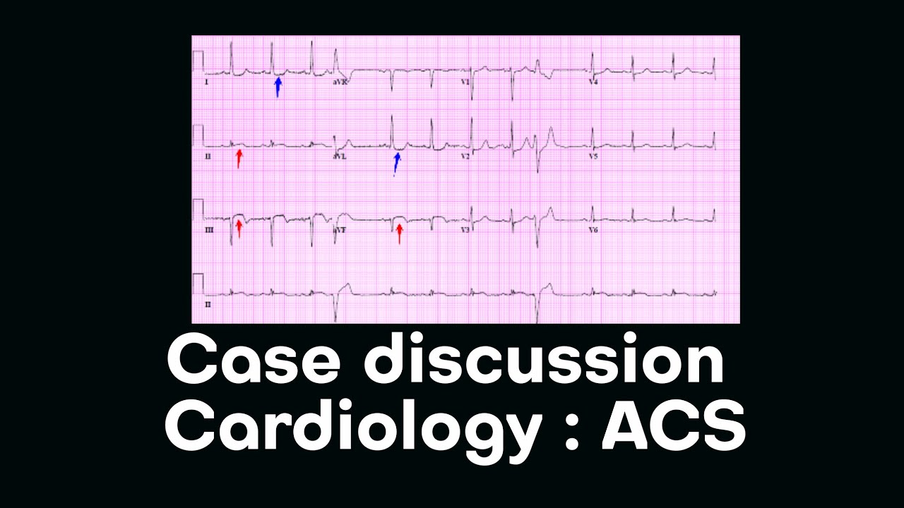 Cardiology case discussion || ACS || Emergency Medicine