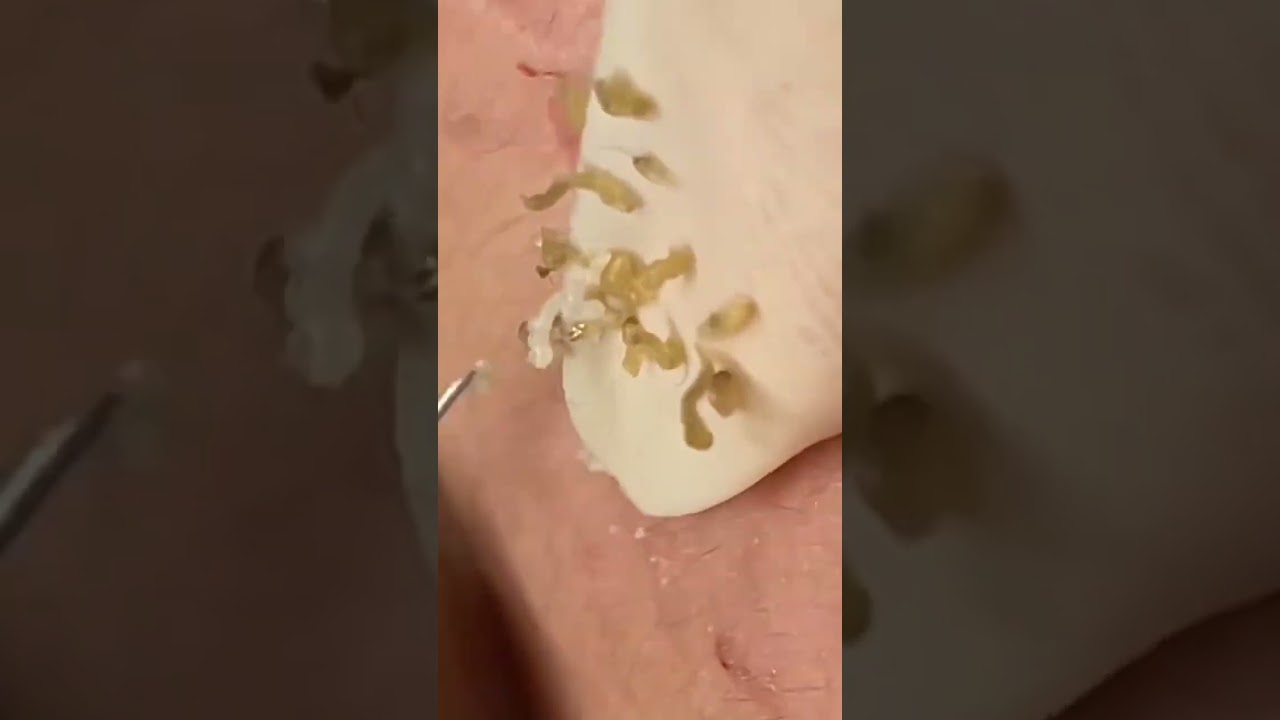 #TextBlackheads Removal  #Text Relax | satisfying   With Din Spa 2025 ⭐ 🐠 😘