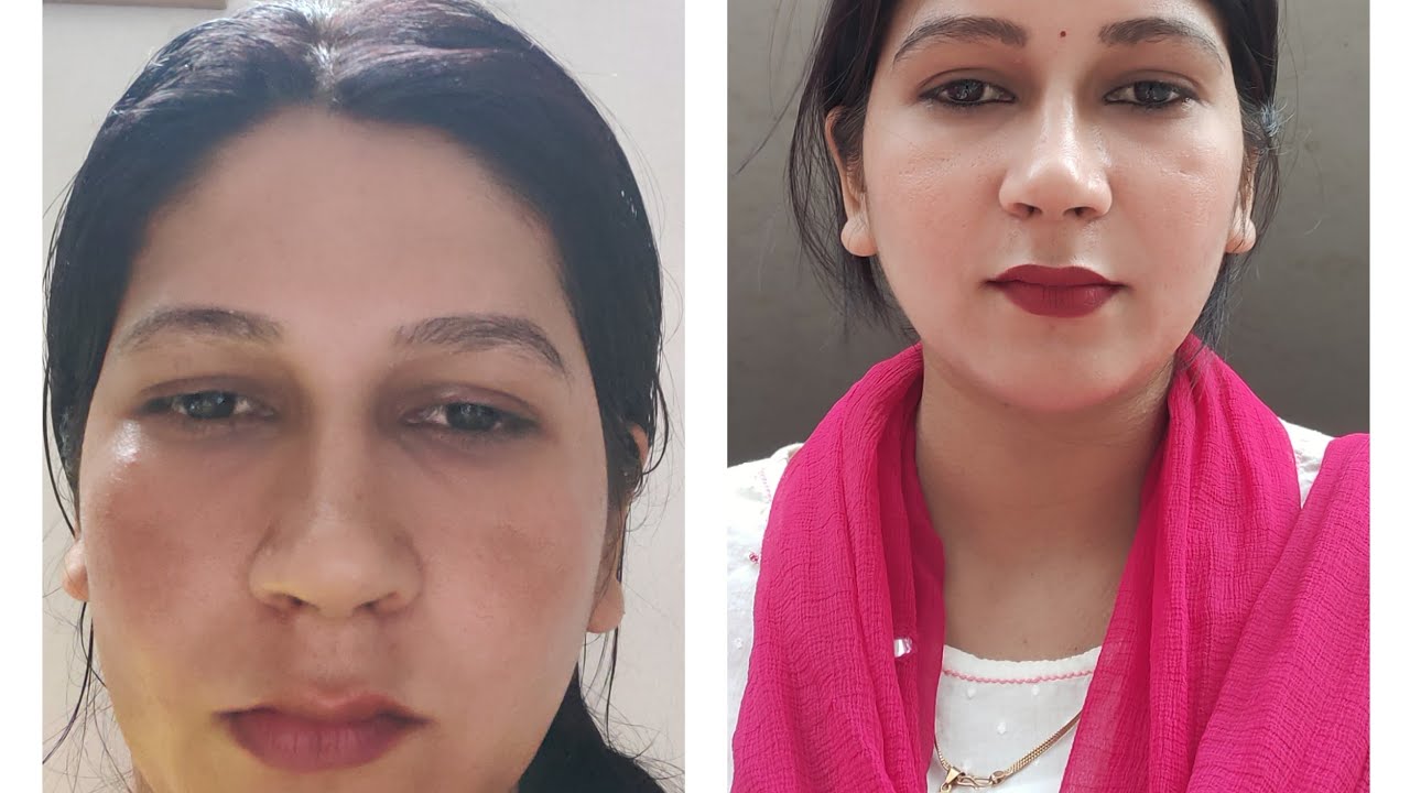 मेरी झाइयों के शुरू होने से ख़त्म होने तक की कहानी।। देखेई कैसे हुई मेरी झाइयां ख़त्म होने तक का सफर