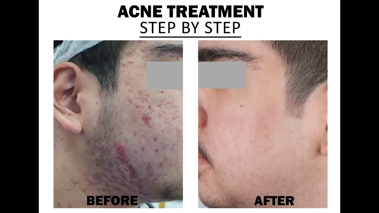 Acne Treatment