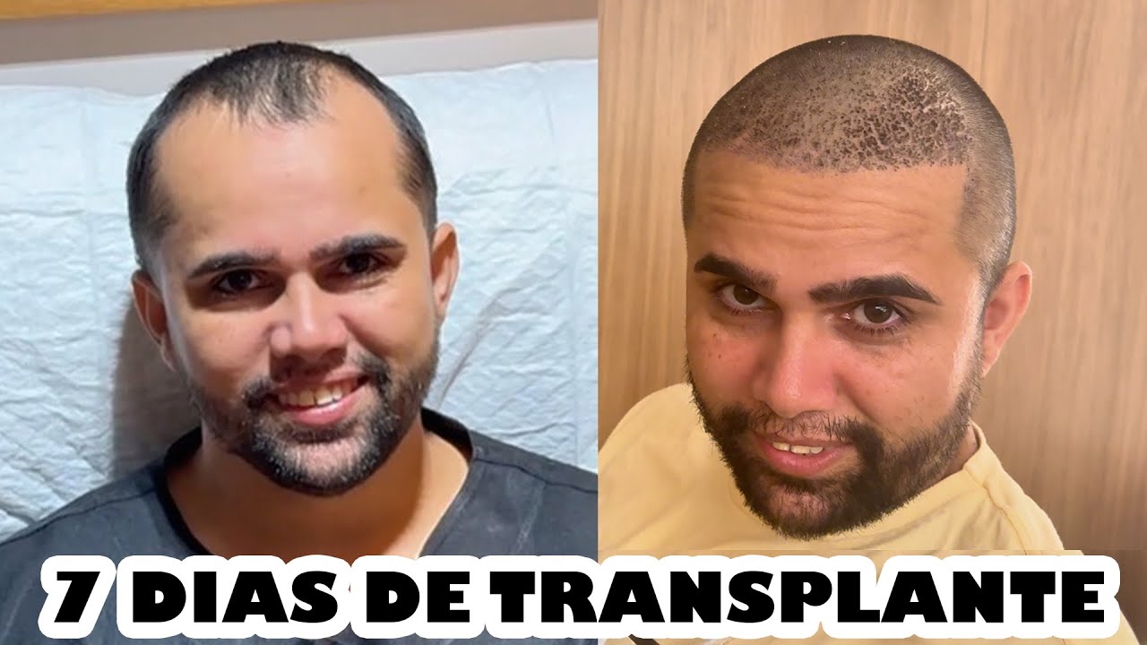 TRANSPLANTE CAPILAR: 7 DIAS APÓS O MEU TRANSPLANTE - PRIMEIRA LAVAGEM TOTAL.