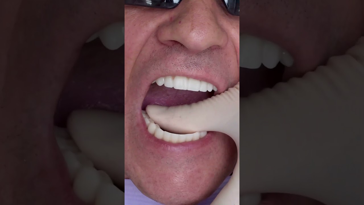 Dental implant&rsquo;s All on 4 in Prague #shorts #dentist #dental #implant #veneers #short