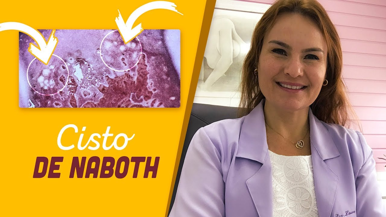 Cisto de Naboth. Por que isso aparece no colo do útero?
