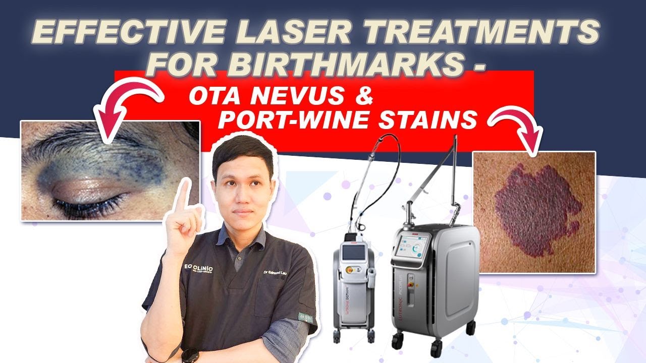 ⁠ ⁠PicoPlus & Derma-V Laser for Birthmark Removal | Ota Nevus & Port-Wine Stains