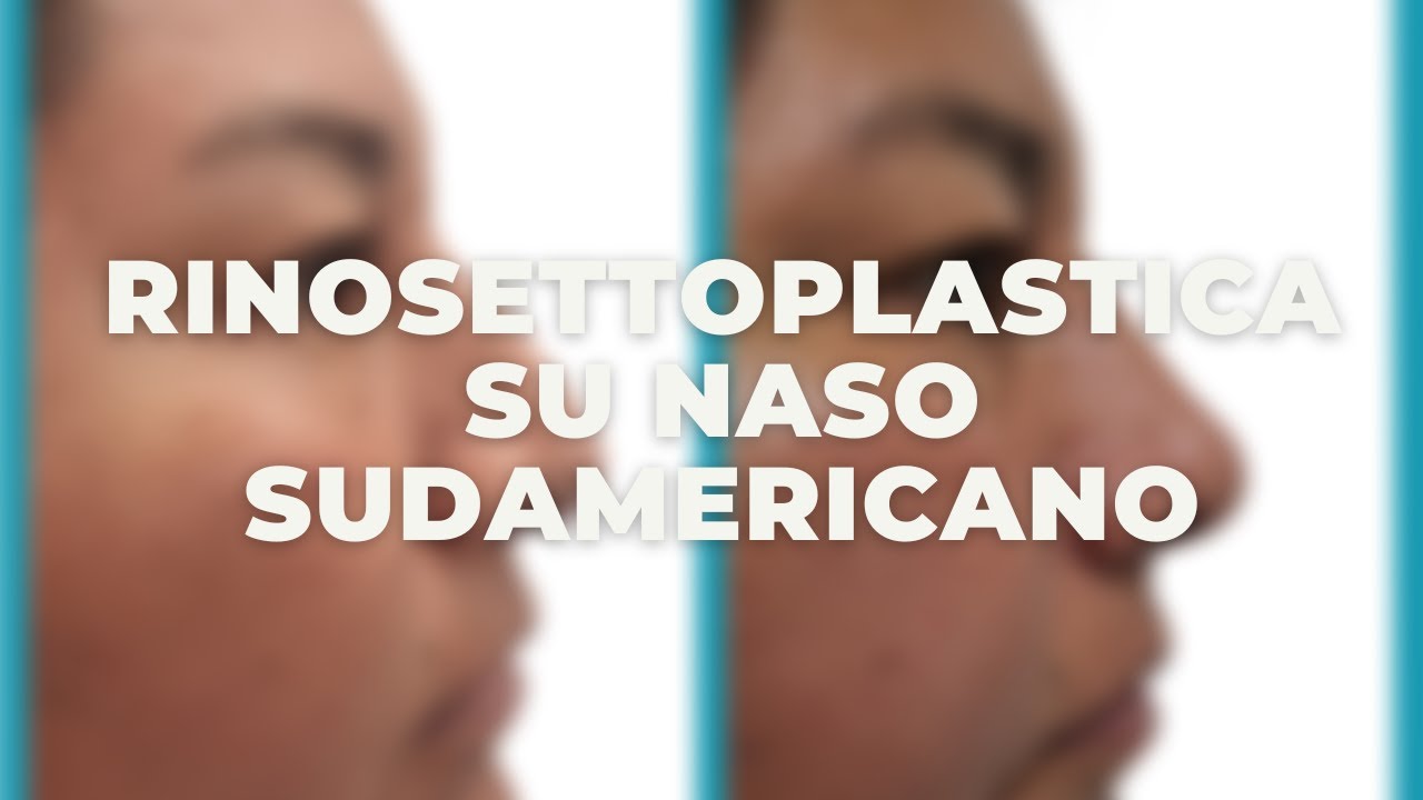 CASO DI RINOSETTOPLASTICA SU NASO ETNICO SUDAMERICANO (ECUADOR)