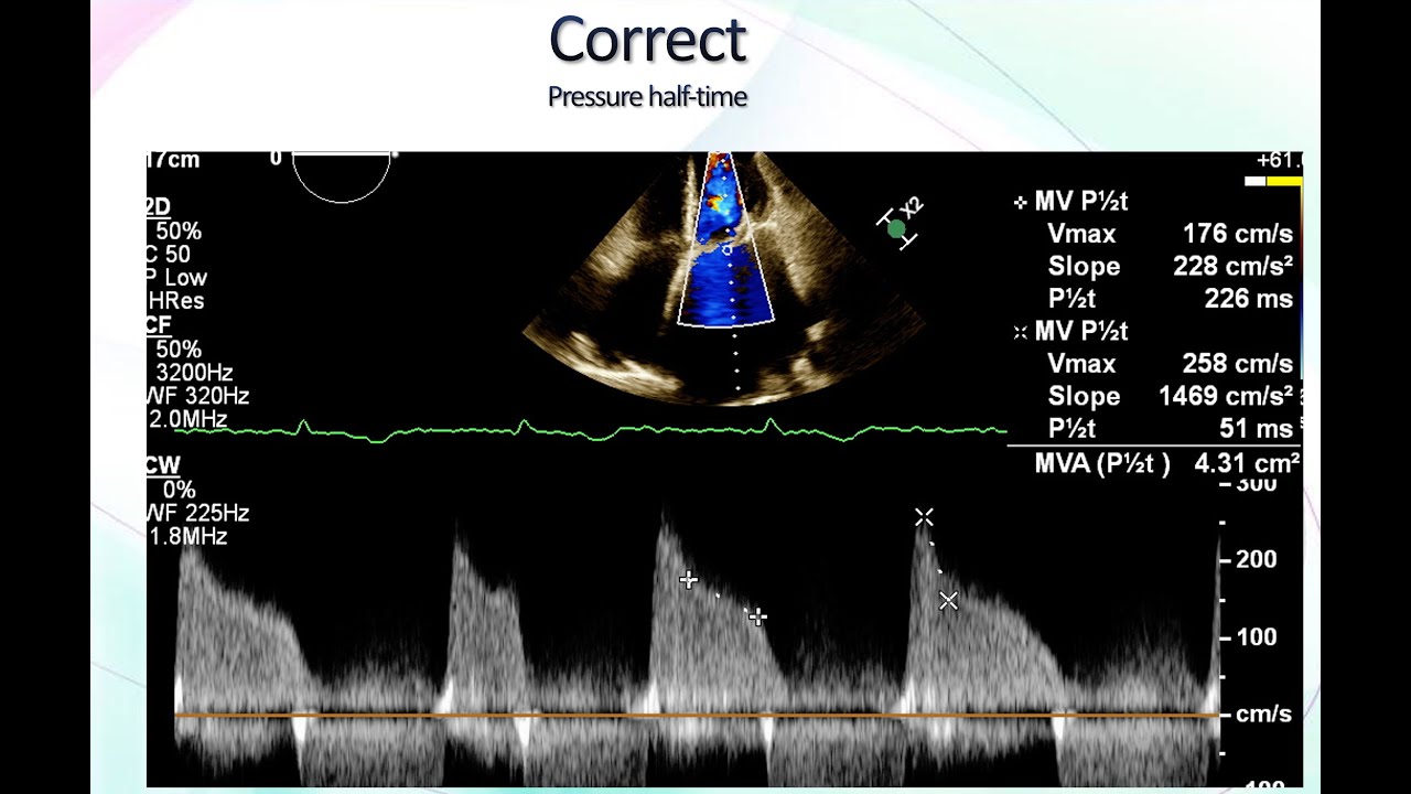 Mitral Stenosis. Echocardiographic Assessment