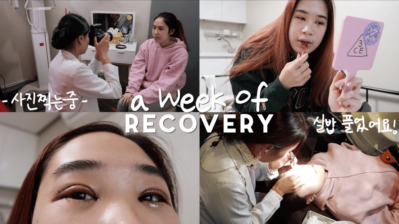 DOUBLE EYELID SURGERY Recovery Vlog in Seoul 👁🕶 (Swelling, Getting Stitches Out)