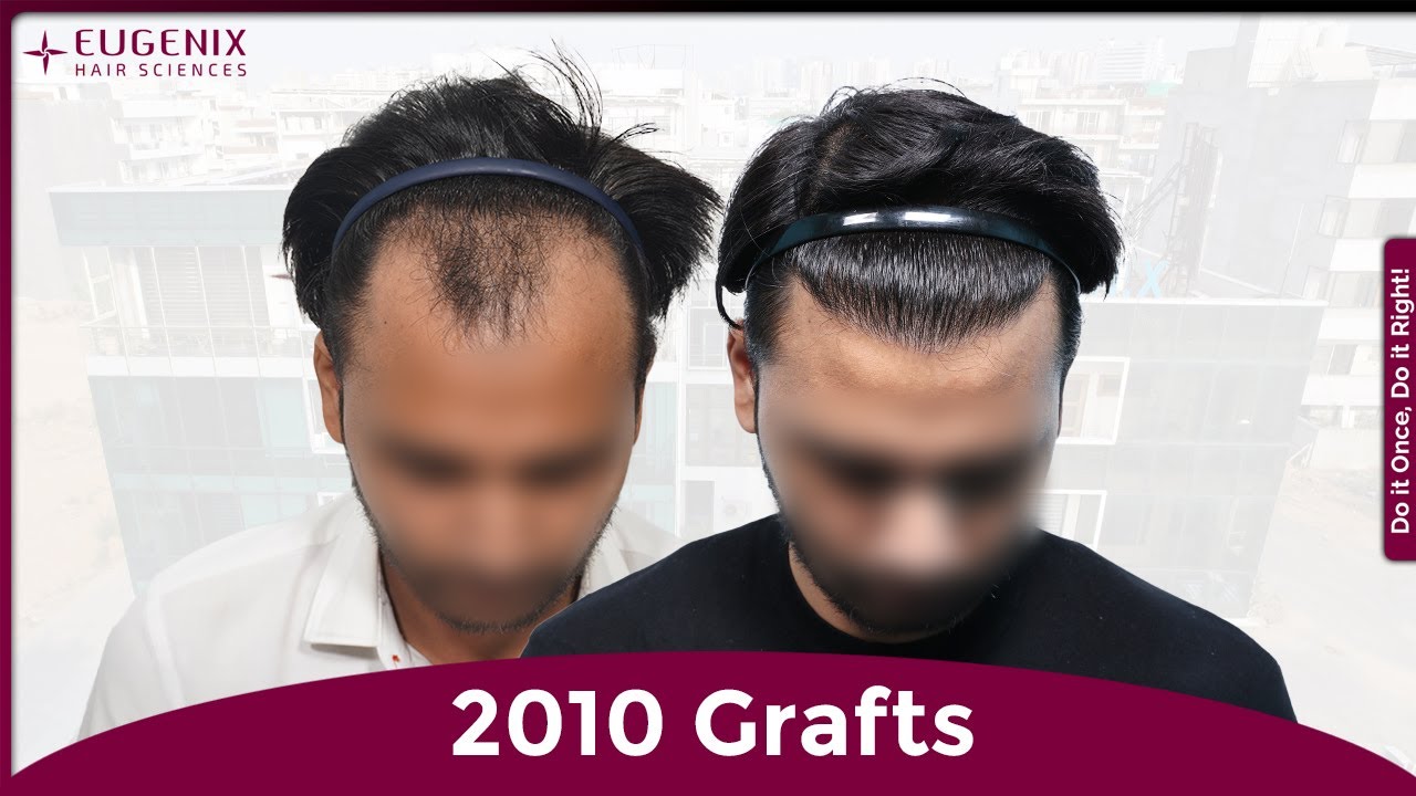From Baldness to Confidence: Advocate’s Hair Transplant Journey | 2010 Grafts Result