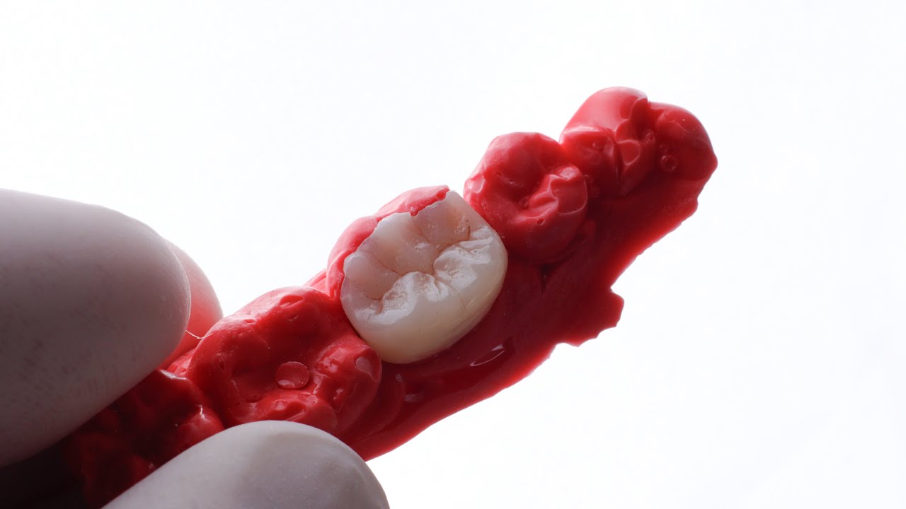 Escultura indireta, primeiro molar inferior.