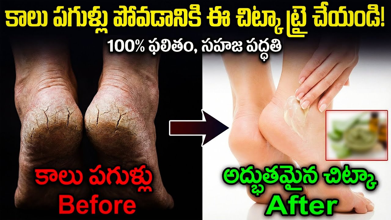 Cracked Heels Home Remedy | పాదాల పగుళ్లను పూర్తిగా నయం చేసే సహజ మార్గం
