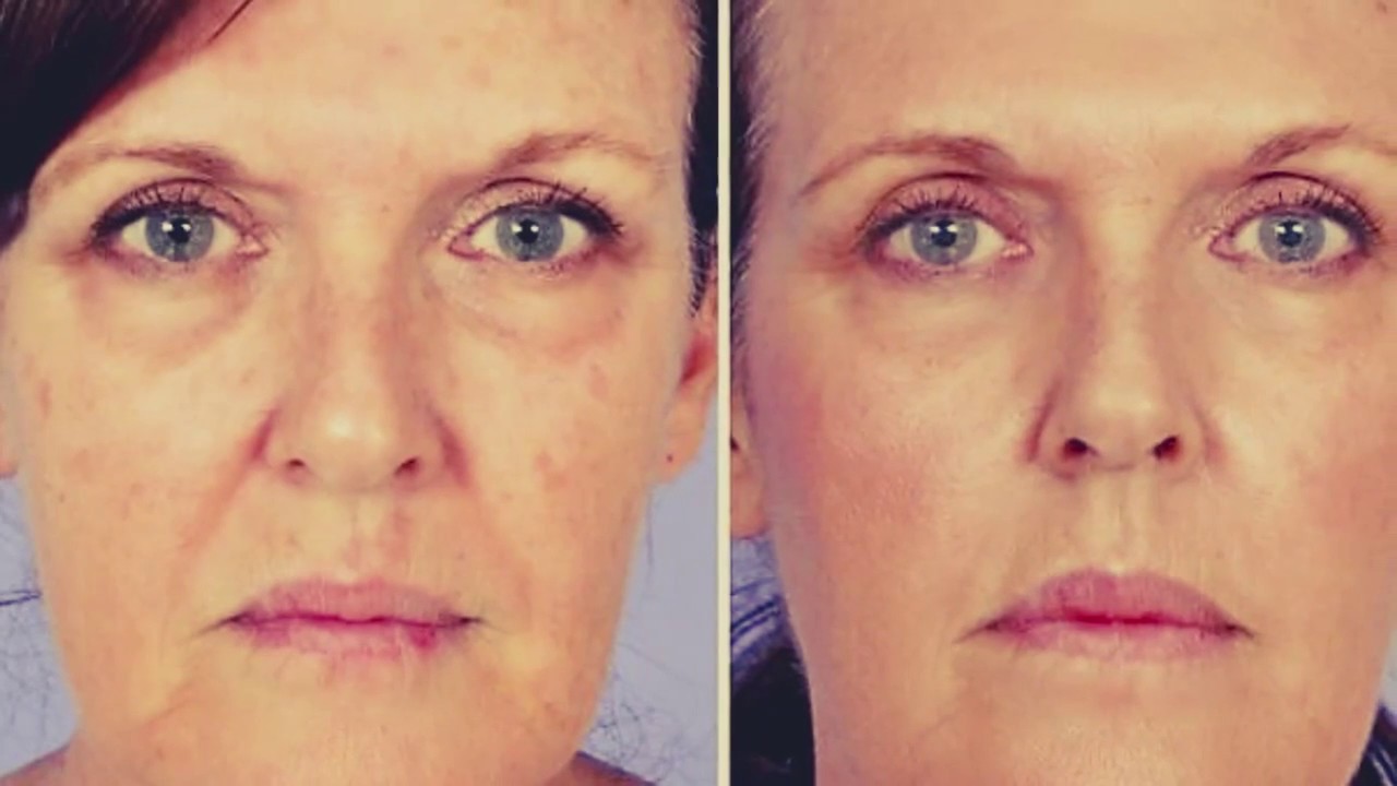 Dermapen microneedling de mooiste voor en na foto's