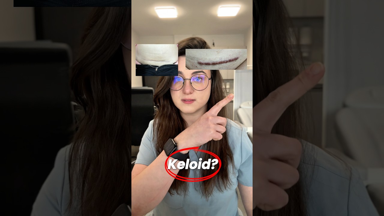 Zwykła blizna vs keloid? 🤔 #medycyna #blizny #bliznowiec #keloid #lekarz #gojenie #krak&oacute;w #edukacja