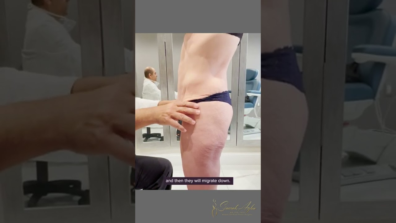 Lower Body Lift — Educational Pre-Op