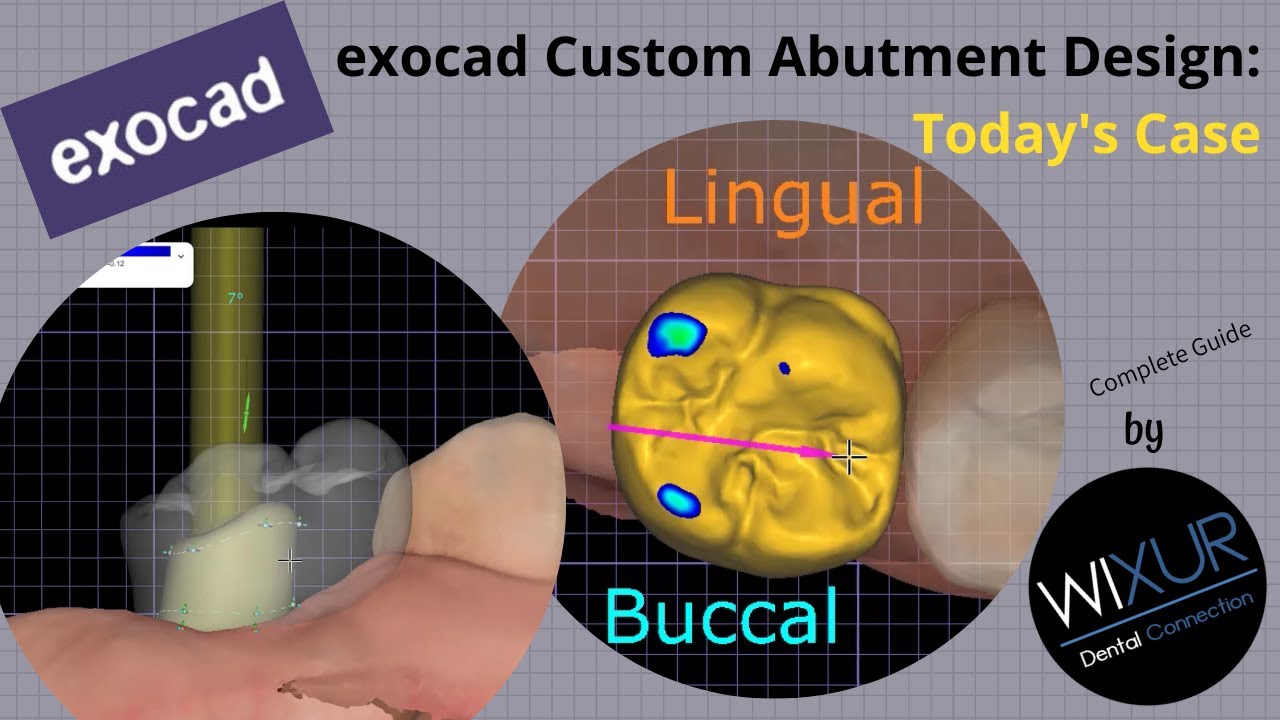 exocad Custom Abutment Design: Today's Case