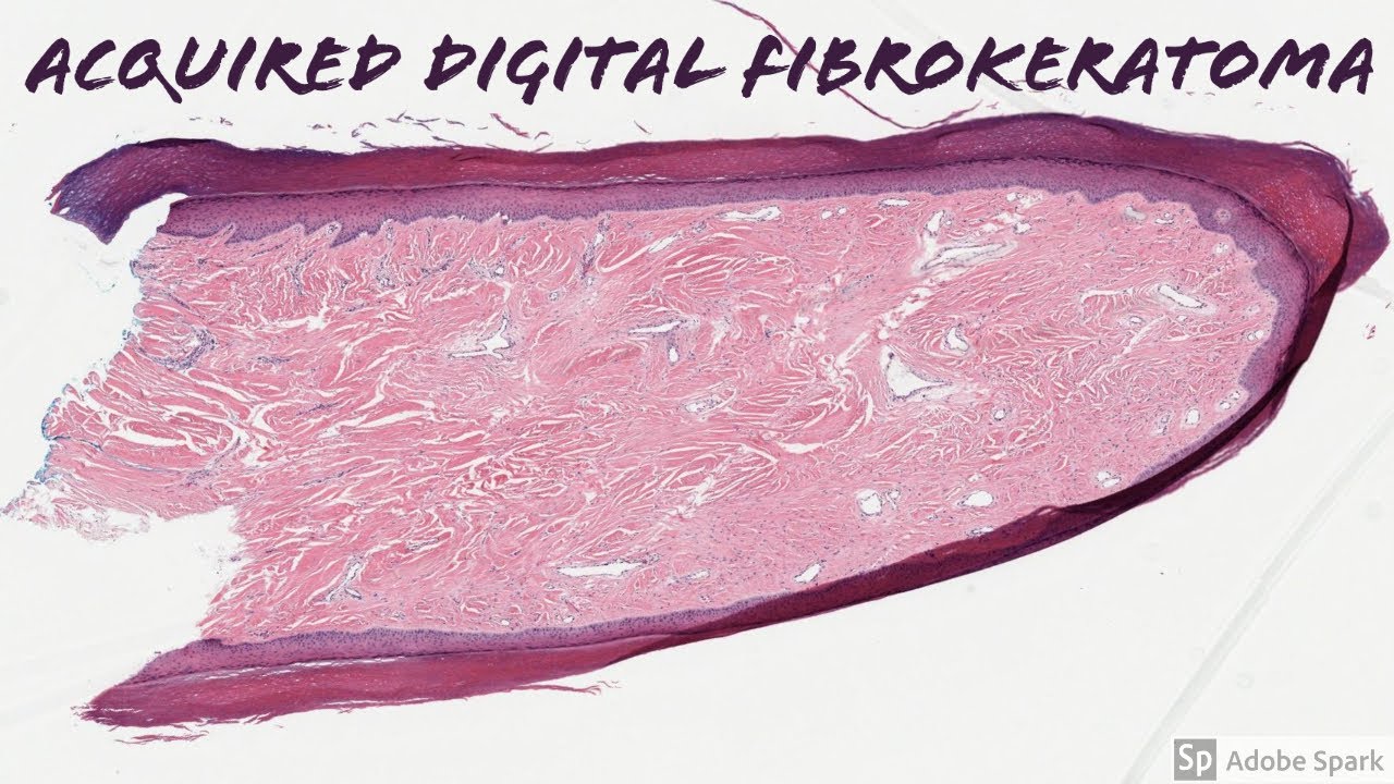 Acquired Digital Fibrokeratoma: 5-Minute Pathology Pearls