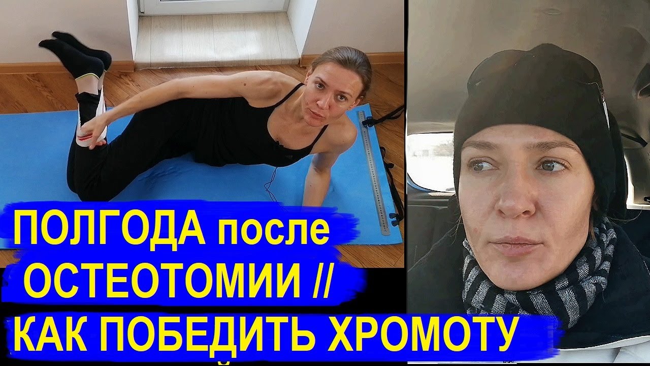 Полгода после ТРОЙНОЙ ОСТЕОТОМИИ ТАЗА // ПРОСТЫЕ упражнения для ИЗБАВЛЕНИЯ  ОТ ХРОМОТЫ