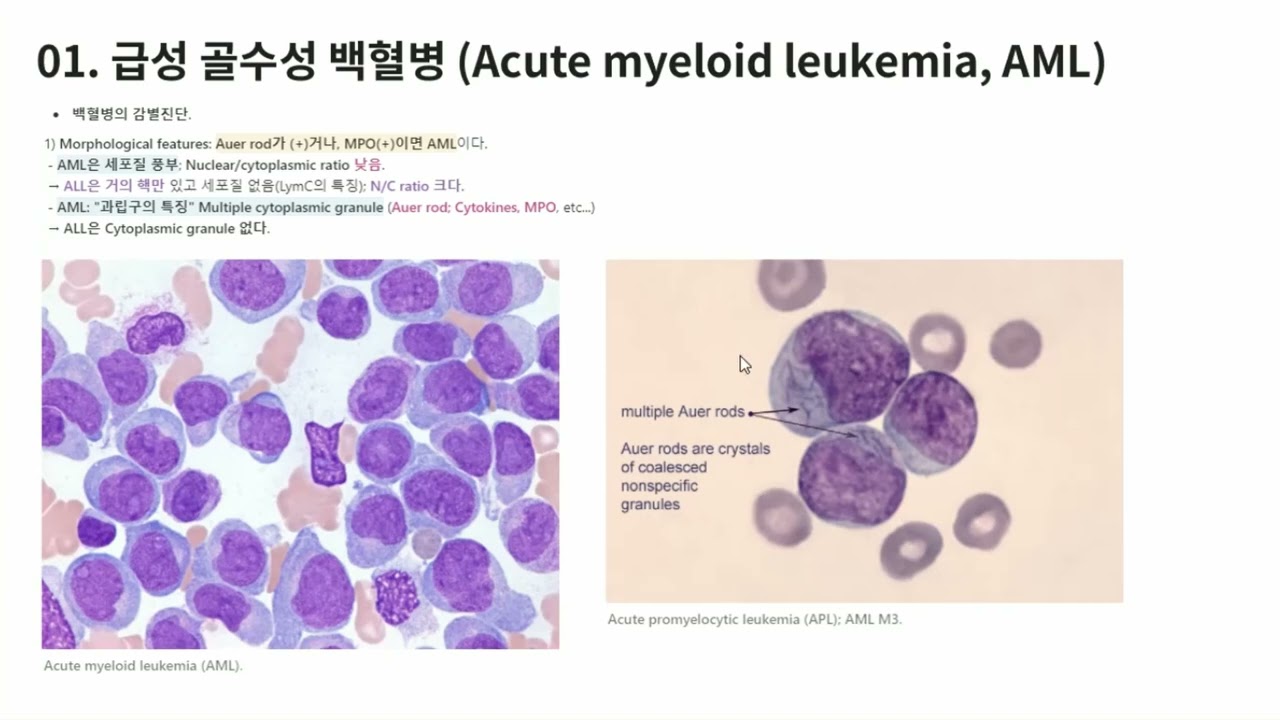 KMLE 강의 시리즈 -  Hematology, 9) 급성 백혈병 (혈액종양 1)